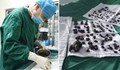 Лекари извадиха 200 камъка от жлъчката на жена