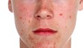 Пъпките по лицето показват от какво боледувате