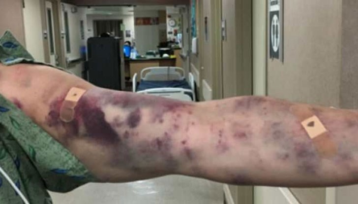 Ръката му се покрила в синини и започнала да се обездвижва