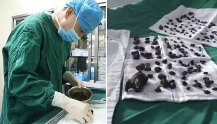 Лош хранителен навик довел до това