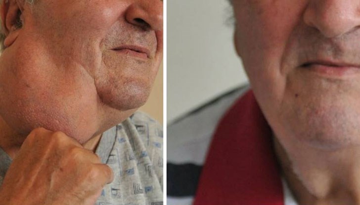 20-сантиметровото образувание растяло в продължение на 20 години