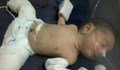Лекари останаха изумени от бебе, „бременно” със своя близнак