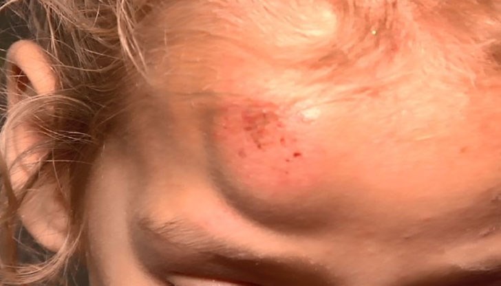 Момичето е с хематом на главата и със съмнения за комоцио