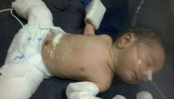 Медиците открили наполовина формиралия се брат в корема на новороденото