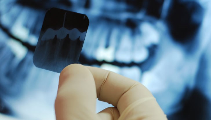 97% от пациенти с рак са минали процедура за вадене на нерви от болен зъб
