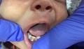 Лекари извадиха 7 зъба на едномесечно бебе