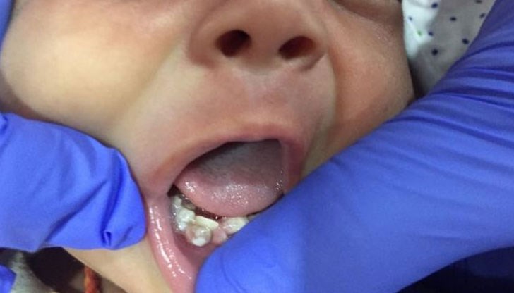 Зъбите на бебето са открити няколко дни след раждането му