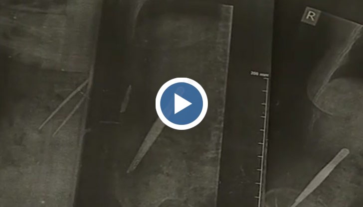 15-сантиметровата пинсета е забравена след операция, сега ѝ искат 10 000 лева да я извадят