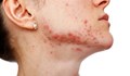 10 заблуди за акнето, на които не трябва да вярвате
