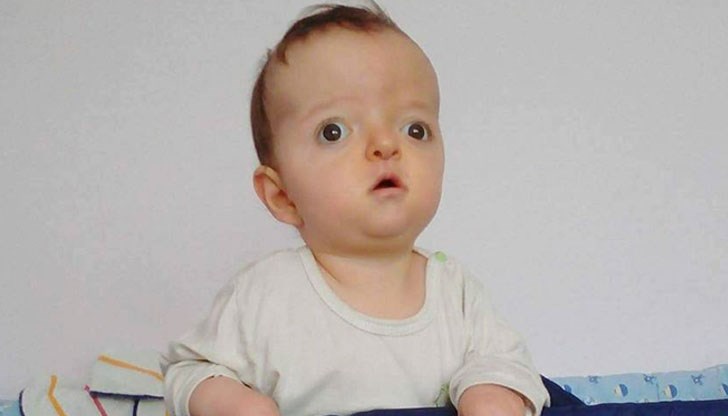 Това е генетично заболяване, което се изразява с типичните малформации на черепа, лицето и крайниците