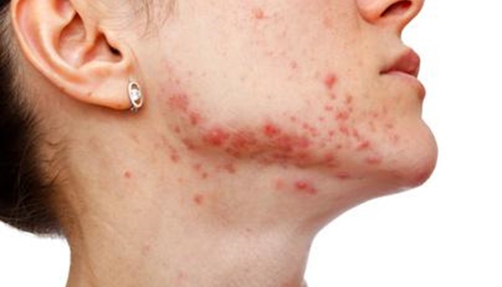 Акнето е възпалително заболяване на кожата, което може да предизвика много притеснения и дискомфорт