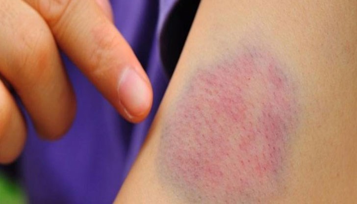 Имате синина, но изобщо не си спомняте да сте се удряли някъде? Имате синина, но изобщо не си спомняте да сте се удряли някъде?