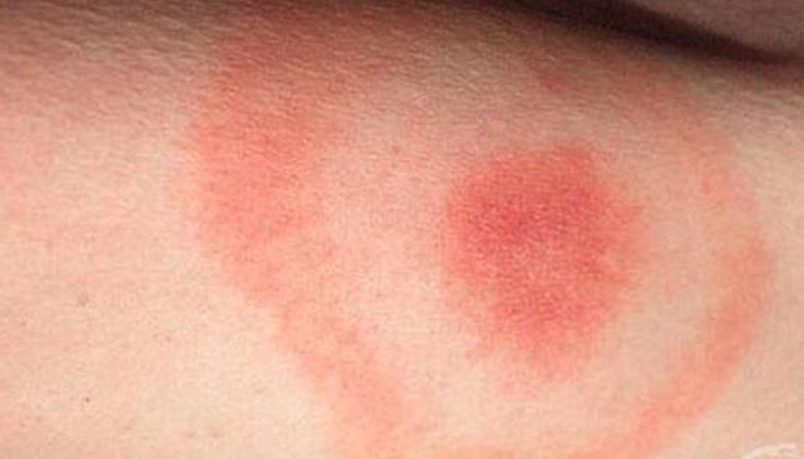 Изключително рядко се среща подобна зараза през зимните месеци Изключително рядко се среща подобна зараза през зимните месеци