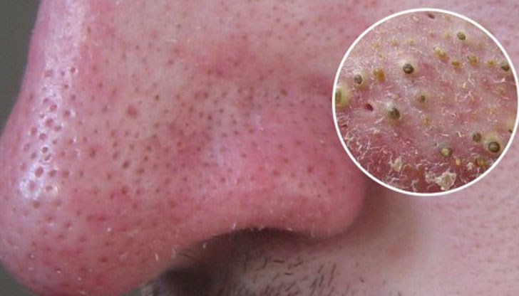 Тази процедура изсмуква черните точки по-ефикасно от прахосмукачка!