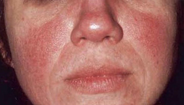 Наблюдава се при хора с по-светла кожа, като се среща и при двата пола между 30-ата и 50-ата година от живота Наблюдава се при хора с по-светла кожа, като се среща и при двата пола между 30-ата и 50-ата година от живота