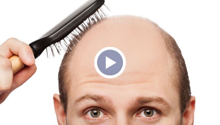Мъжете няма защо да се притесняват от загубата на коса - жените в действителност ги намират за по-мъжествени