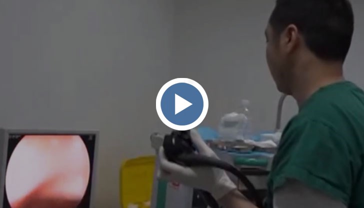 Пациентът доверил на докторите, че случайно глътнал запалката преди 20 години, но тогава не потърсил медицинска помощ