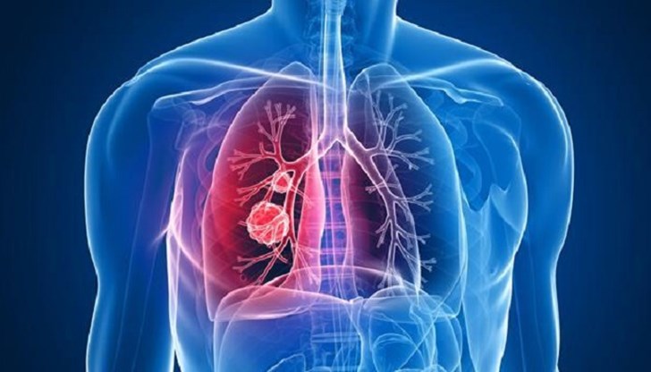 В България карциномът на белия дроб е най-честото злокачествено заболяване при мъжете и петото по честота при жените