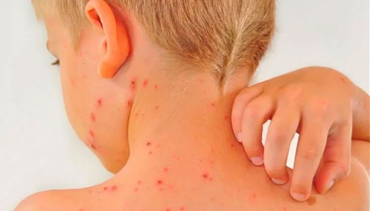 Педиатри предполагат, че една от причините са сборните групи в детските ясли и градини през лятото, където според тях санитарният контрол не е достатъчен Педиатри предполагат, че една от причините са сборните групи в детските ясли и градини през лятото, където според тях санитарният контрол не е достатъчен