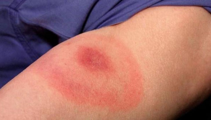 Регистриран е и случай на Лаймска болест Регистриран е и случай на Лаймска болест