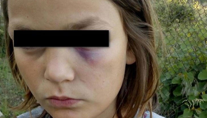Така изглежда малката Ивелина след удара в окото от съученик