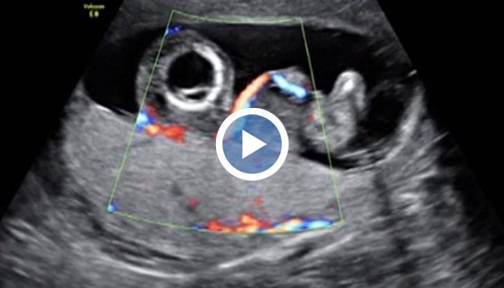 След уникалната операцията бебето се ражда напълно здраво