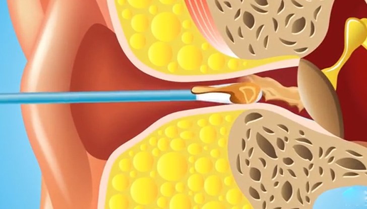 Употребата на клечки за уши вреди на здравето ни Употребата на клечки за уши вреди на здравето ни
