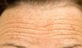 Дълбоките бръчки на челото разкриват рискове за здравето