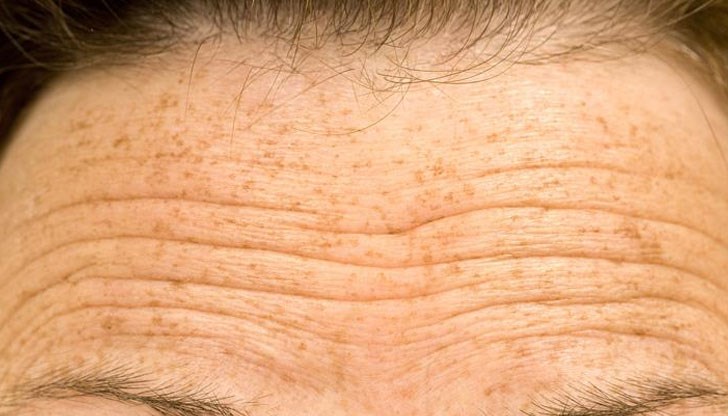 Тези хора са изложени на 10 пъти по-голям риск да починат от атеросклероза, констатираха френски учени