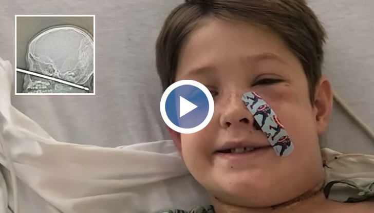 Детето е паднало върху шиша, който е пронизал главата му от лицето до тила