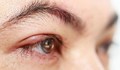 5 бабини лека срещу ечемик на окото