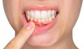 Натурални начини за премахване на зъбния камък