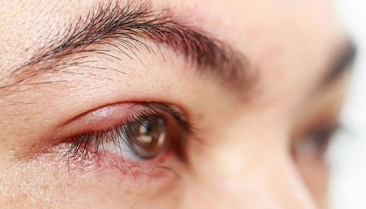 Ечемикът може да бъде преодолян със средства, които се намират във всеки дом Ечемикът може да бъде преодолян със средства, които се намират във всеки дом