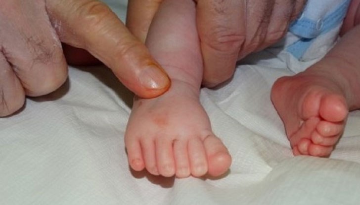 Състоянието е изключително рядко и лечението му е само оперативно Състоянието е изключително рядко и лечението му е само оперативно