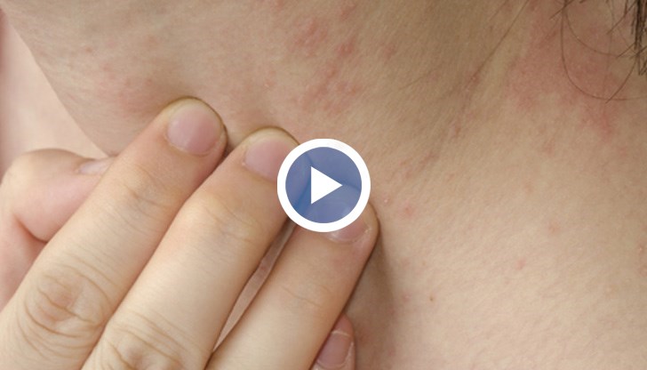 Симптомите са болки по откритите части на тялото и обриви