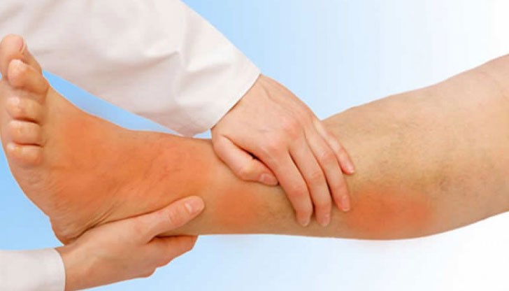 Болка в краката по време на ходене може да бъде признак за запушени артерии