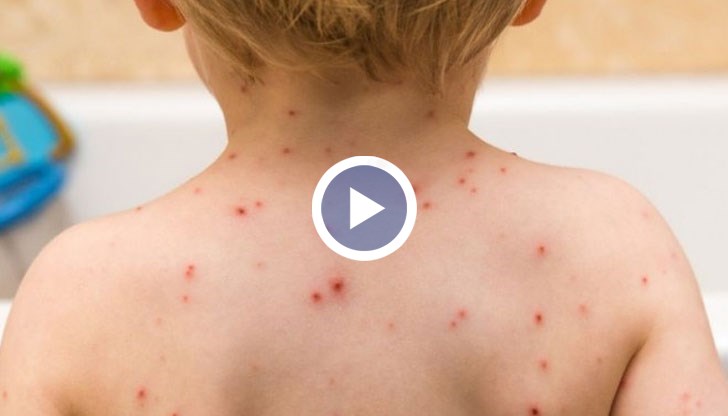 Останалите случаи, при които има симптоми на морбили, още не са доказани лабораторно