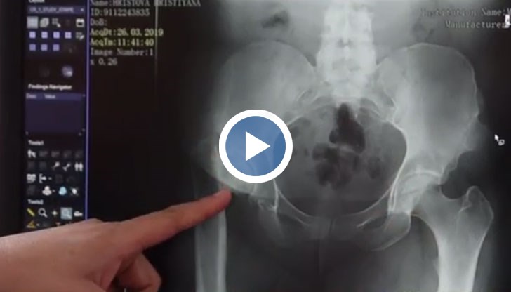 28-годишната пациентка на панагюрската болница е с вродена деформация на тазобедрената става