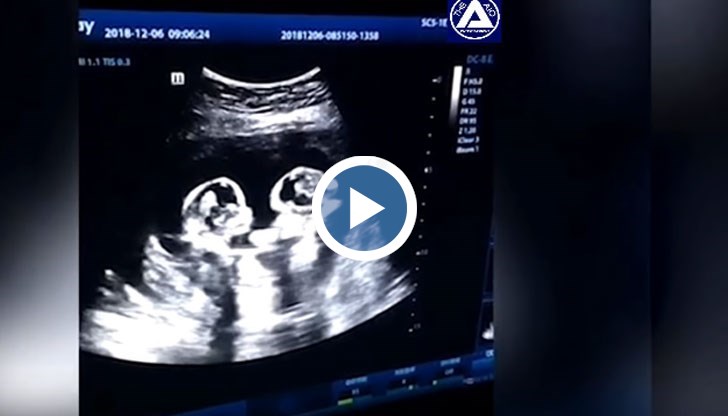 Таткото е заснел как двете неродени момиченце се боксират в утробата на майка си