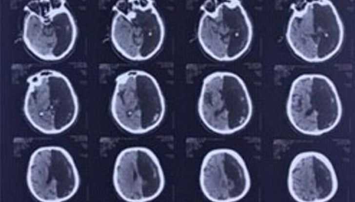 Разбира чак когато е на 60 години след като прекарва микроинсулт