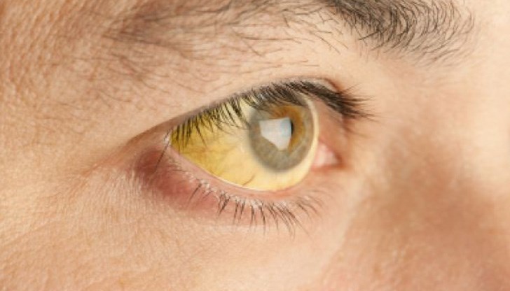 Хепатитът е “мълчалив убиец”, тъй като повечето страдащи не са официално диагностицирани