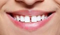 Три решения за премахване на разстоянието между зъбите