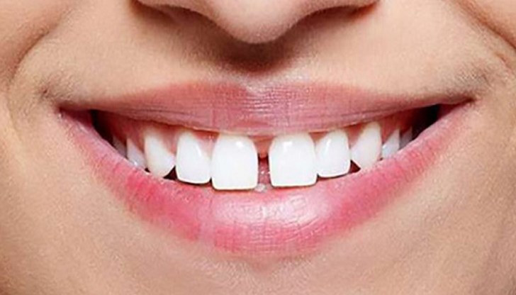 Генетични или физиологични са причините за поява на разстояние между предните зъби – то може да бъде отстранено
