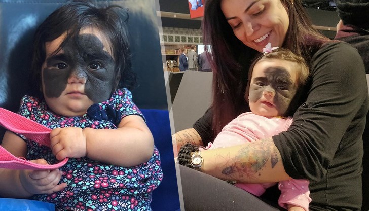 Лекари от Краснодар обещават да помогнат на 6-месечната Луна Фенер да се отърве от гигантския родилен белег на лицето Лекари от Краснодар обещават да помогнат на 6-месечната Луна Фенер да се отърве от гигантския родилен белег на лицето