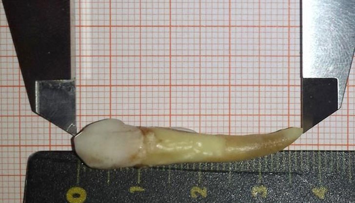 Германски стоматолог и пациентът му получиха сертификат за световен рекорд на Гинес за най-дългия изваден човешки зъб