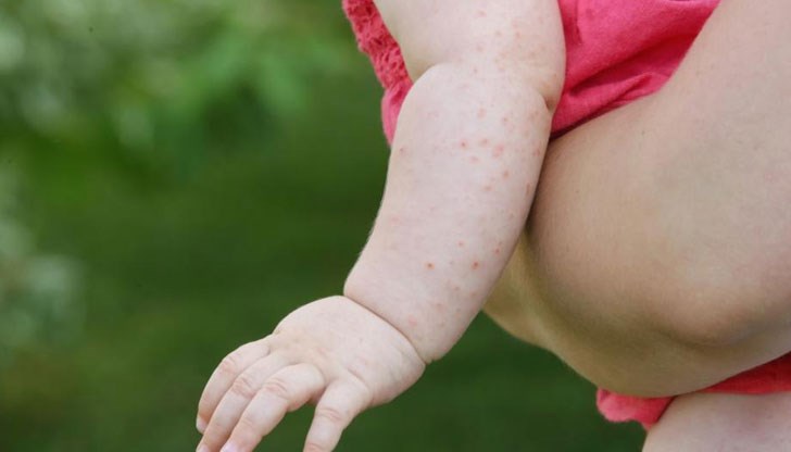 Случаите на заболяването са се увеличили с 300% в целия свят през първите 3 месеца на годината