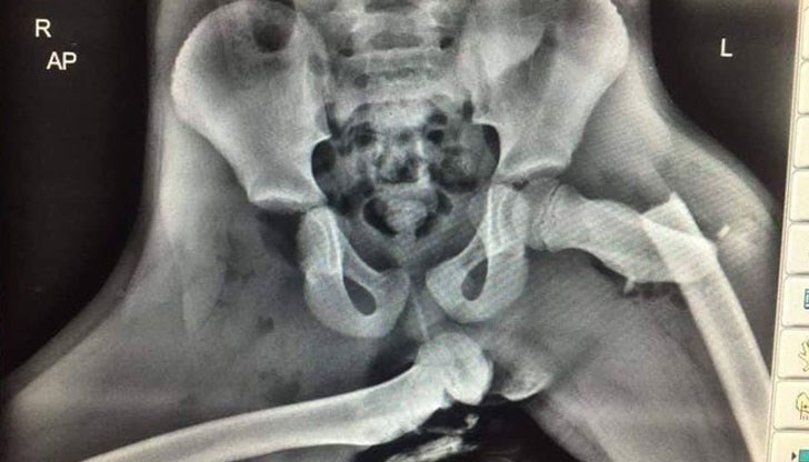Рентгеновата снимка показва последиците за младо момиче, попаднало в катастрофа, докато държало краката си опрени на арматурното табло