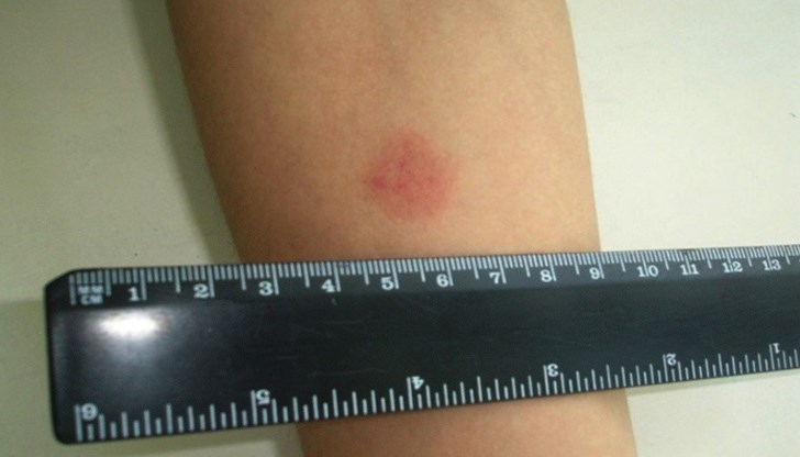 Страни, отказали се от ваксината срещу туберкулоза, в момента са в разгара на епидемията и са силно засегнати Страни, отказали се от ваксината срещу туберкулоза, в момента са в разгара на епидемията и са силно засегнати