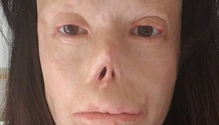 Валентина е напълно обезобразена и днес мъките й продължават с ежедневни болки и страдания