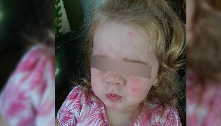 Майката на детето публикува снимки в социалните мрежи, за да илюстрира какво причиняват комарите на малкото й момиченце